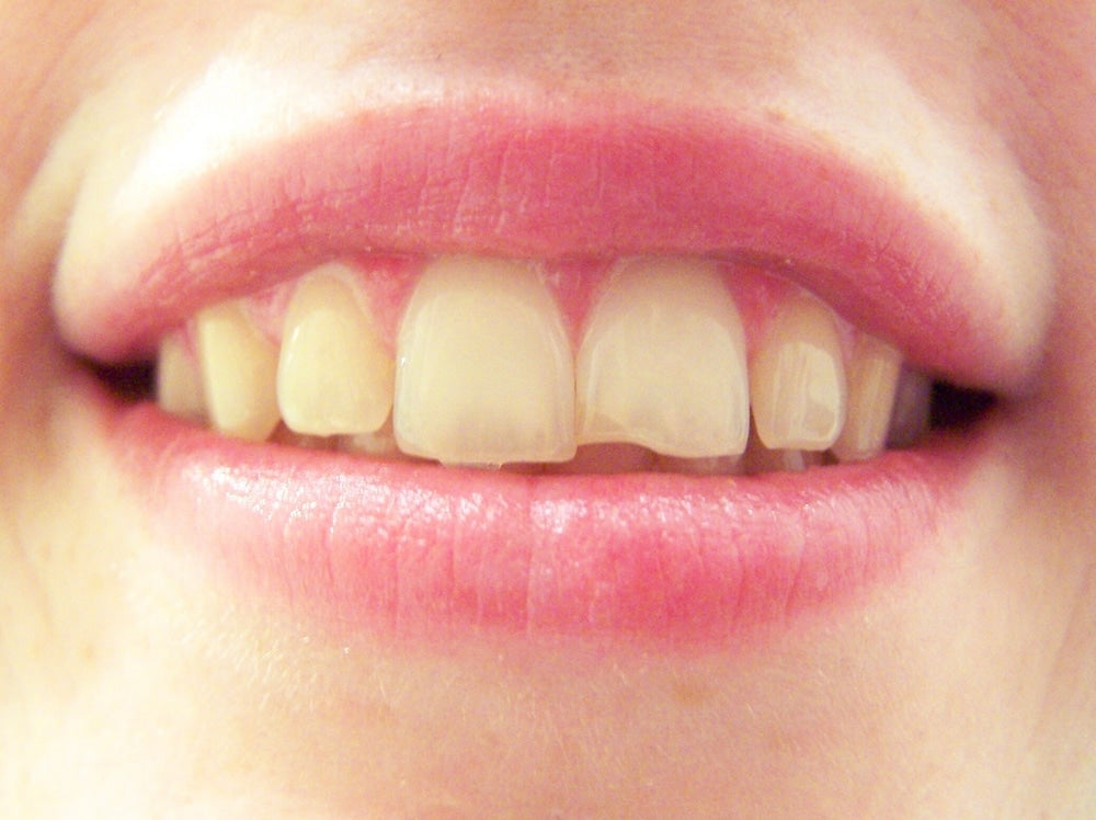 7-ways-to-repair-a-chipped-tooth